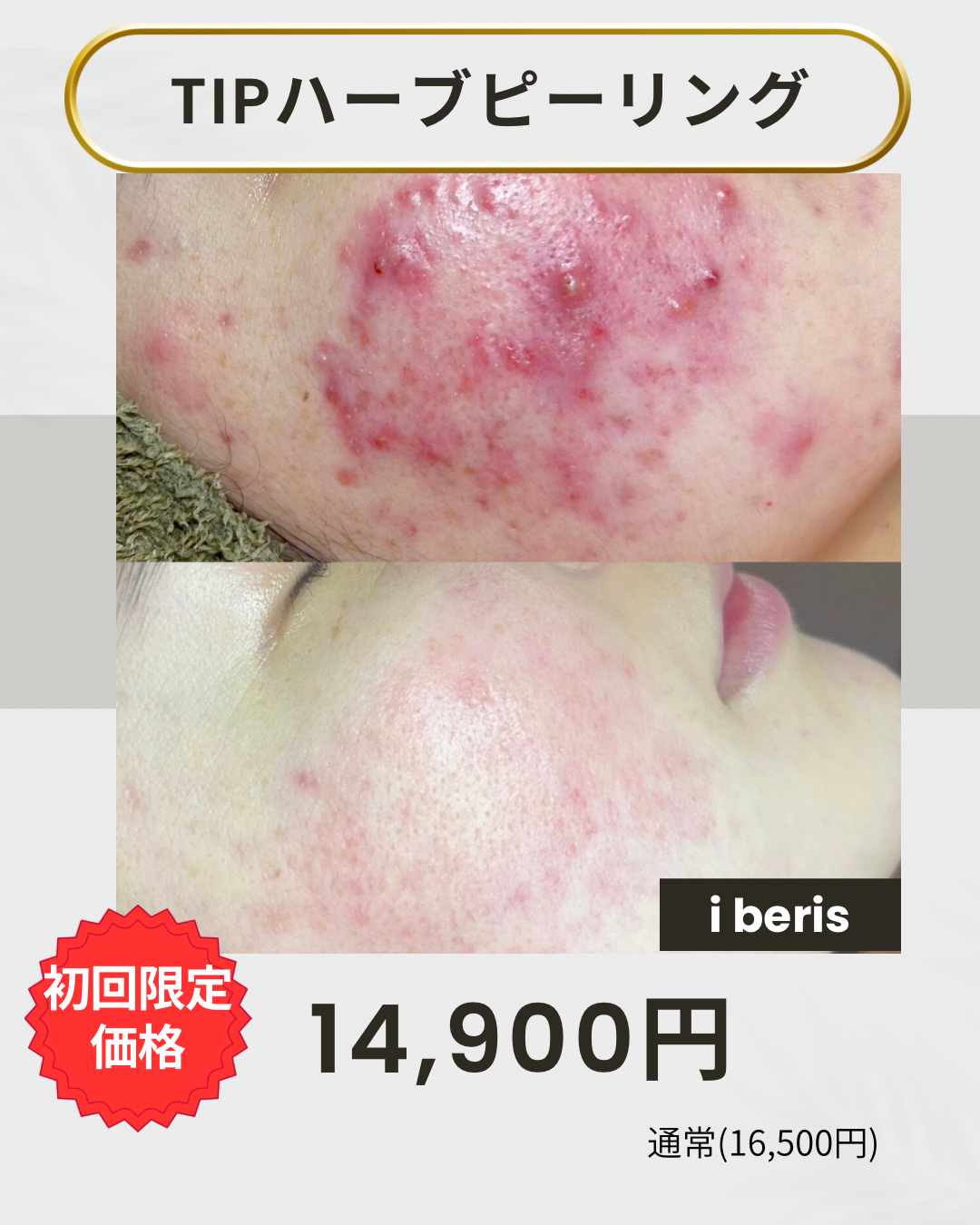 ハーブピーリング | 施術事例 | 山口県宇部市のエステならAlice 毛穴