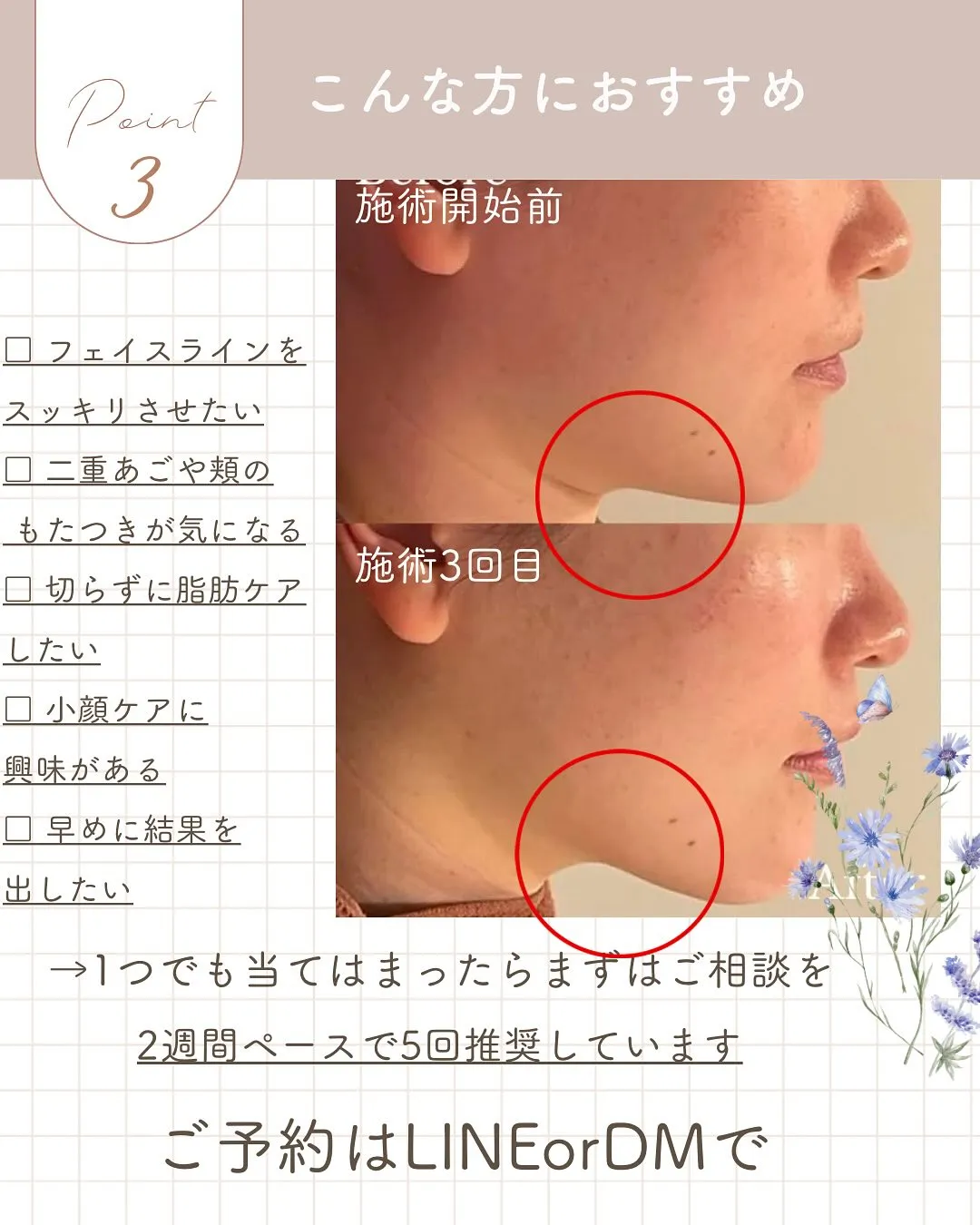 脂肪溶解～レモンボトル～で小顔へ