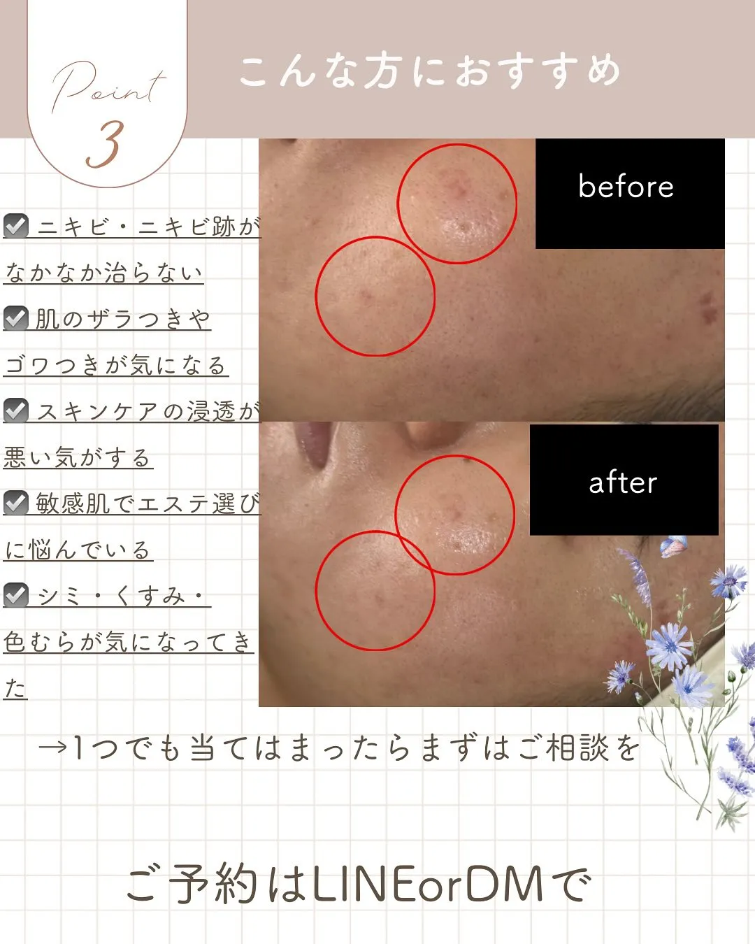 【ニキビ・ゆらぎ肌にお悩みの方へ】