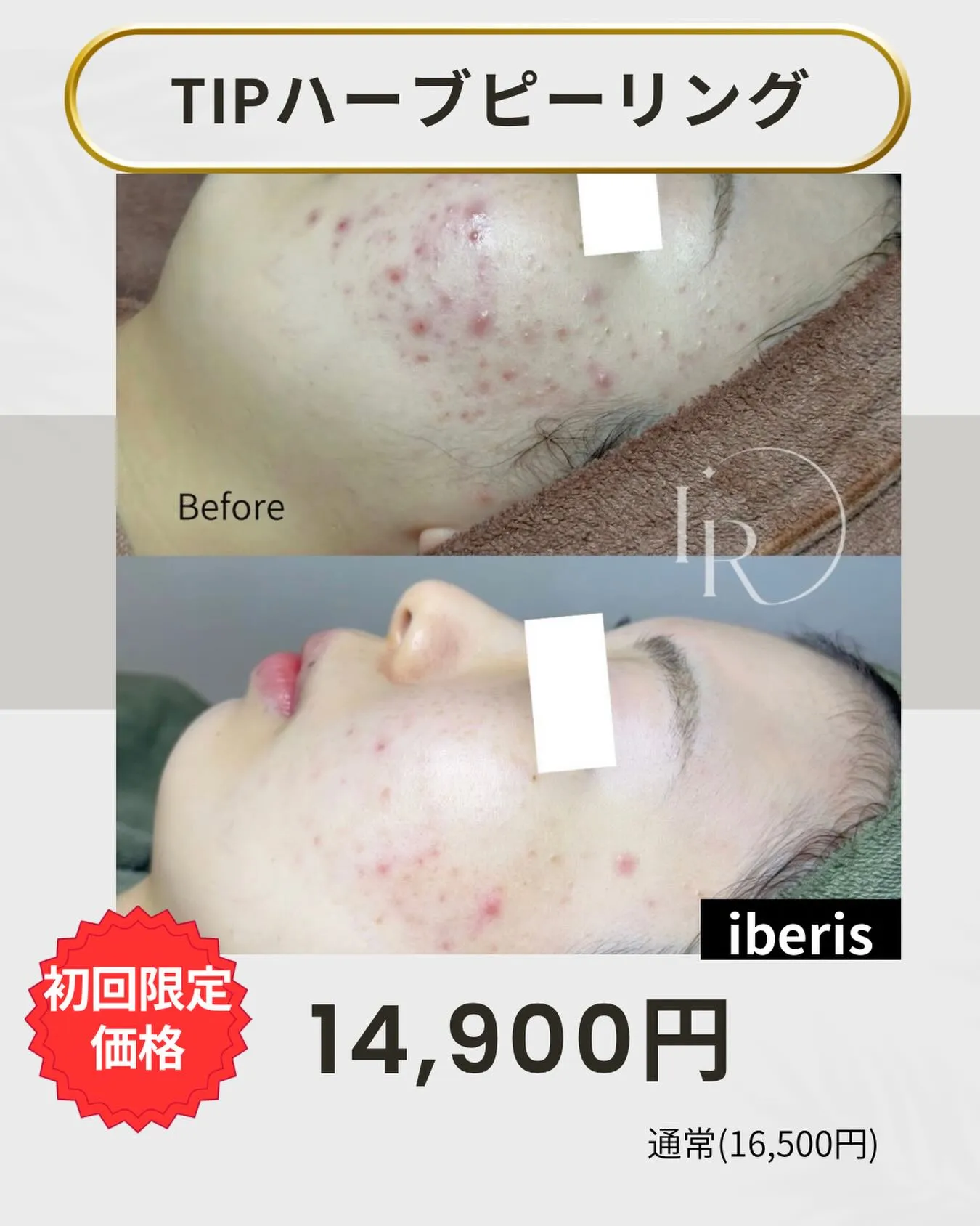 🌿 ニキビ・肌荒れにずっと悩んでいたあなたへ