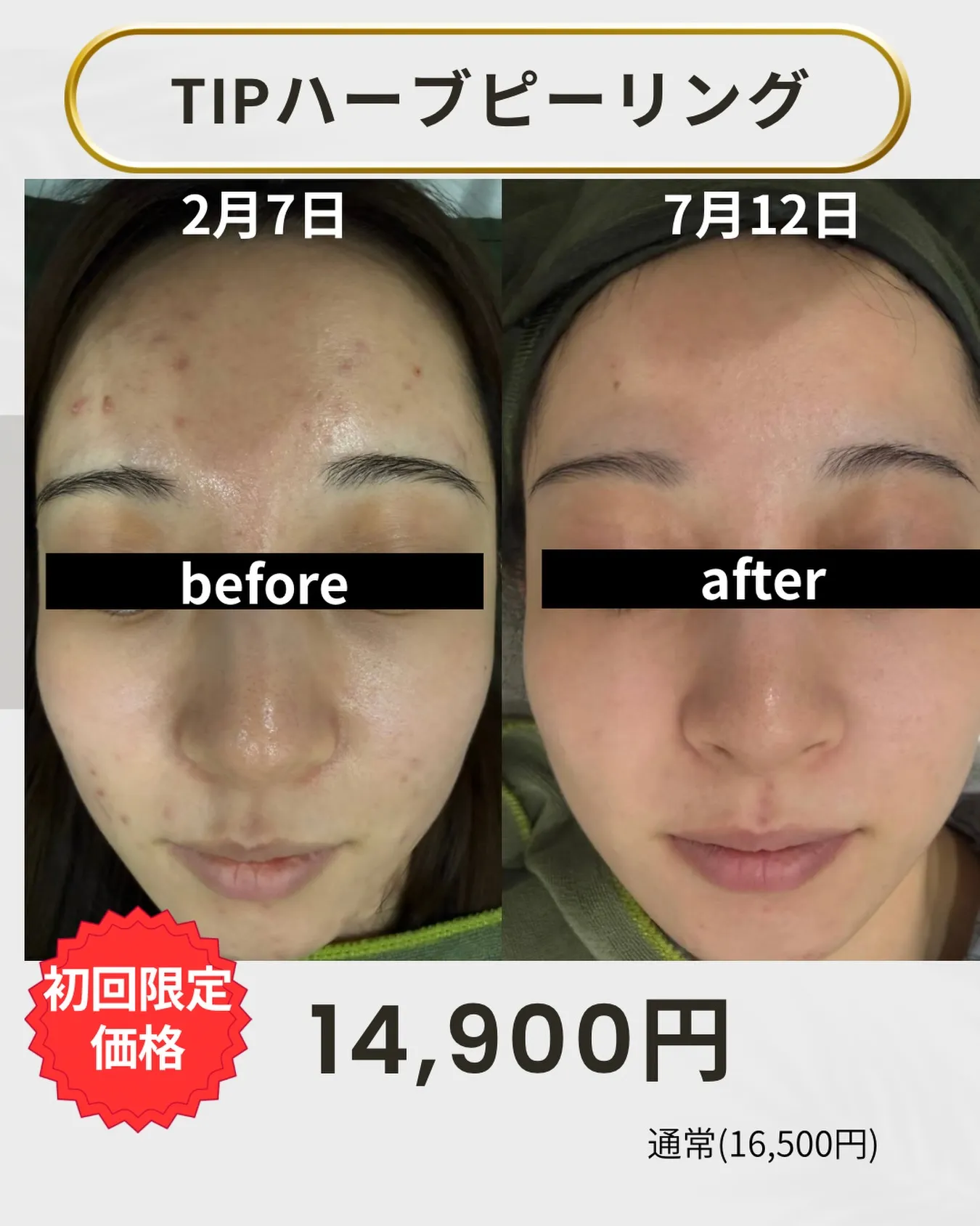 「ハーブピーリング、どれも同じでしょ？」…実は全然違うんです...