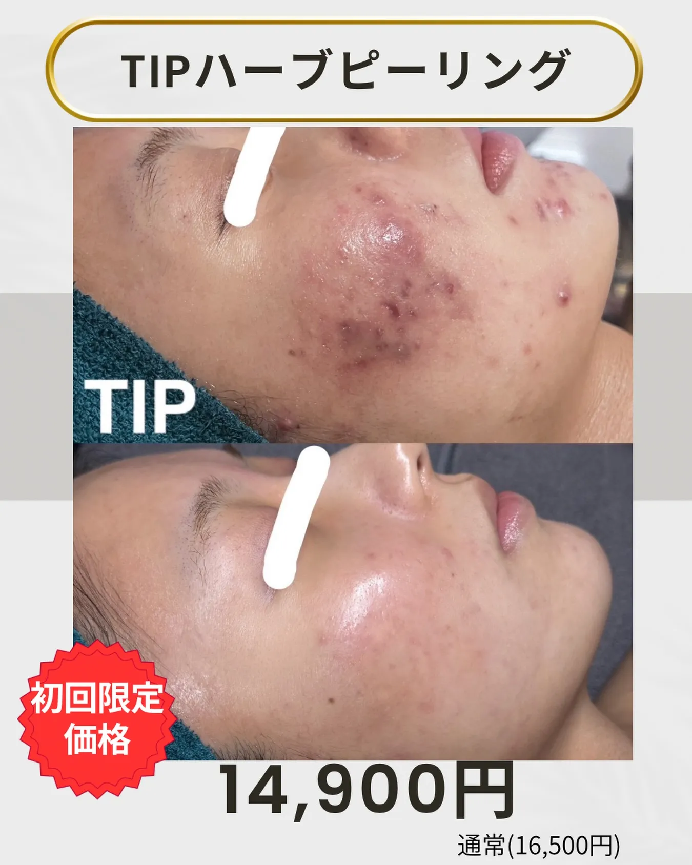 「そのニキビ、“体質だから”と諦めていませんか？」