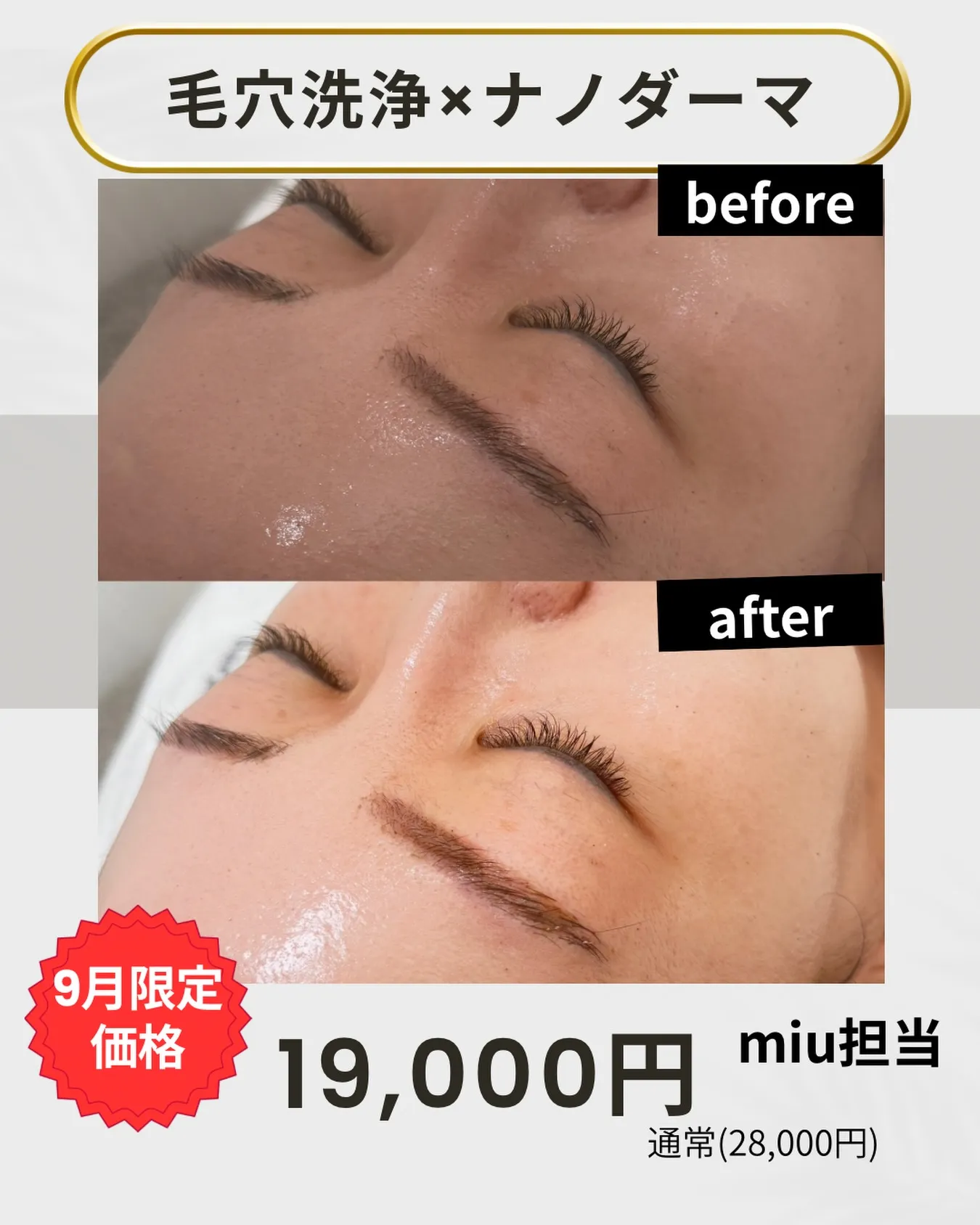 毛穴洗浄だけで終わってない？毛穴の“その先”までキレイにした...