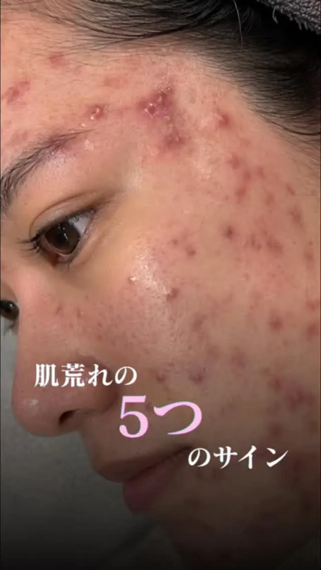 肌がダメージを受けているサイン